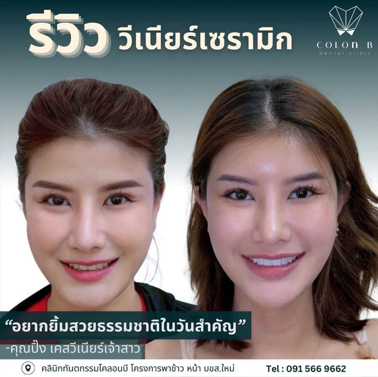 โปรโมชั่นคลินิกทันตกรรมโคลอนบี