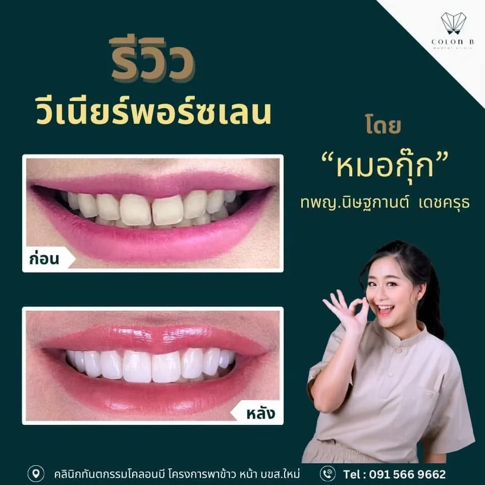 รีวิว วีเนียร์เซรามิก จากคนไข้จริง