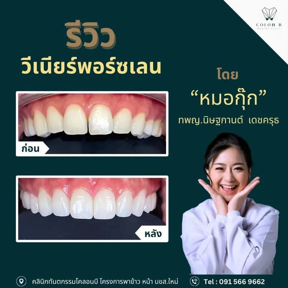 รีวิว วีเนียร์เซรามิก จากคนไข้จริง