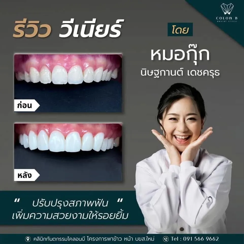 รีวิว วีเนียร์เซรามิก จากคนไข้จริง
