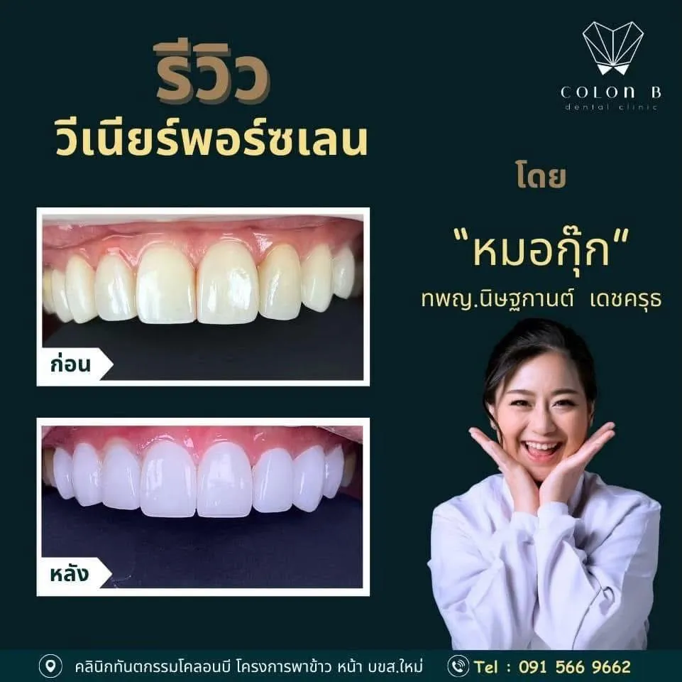 รีวิว วีเนียร์เซรามิก จากคนไข้จริง
