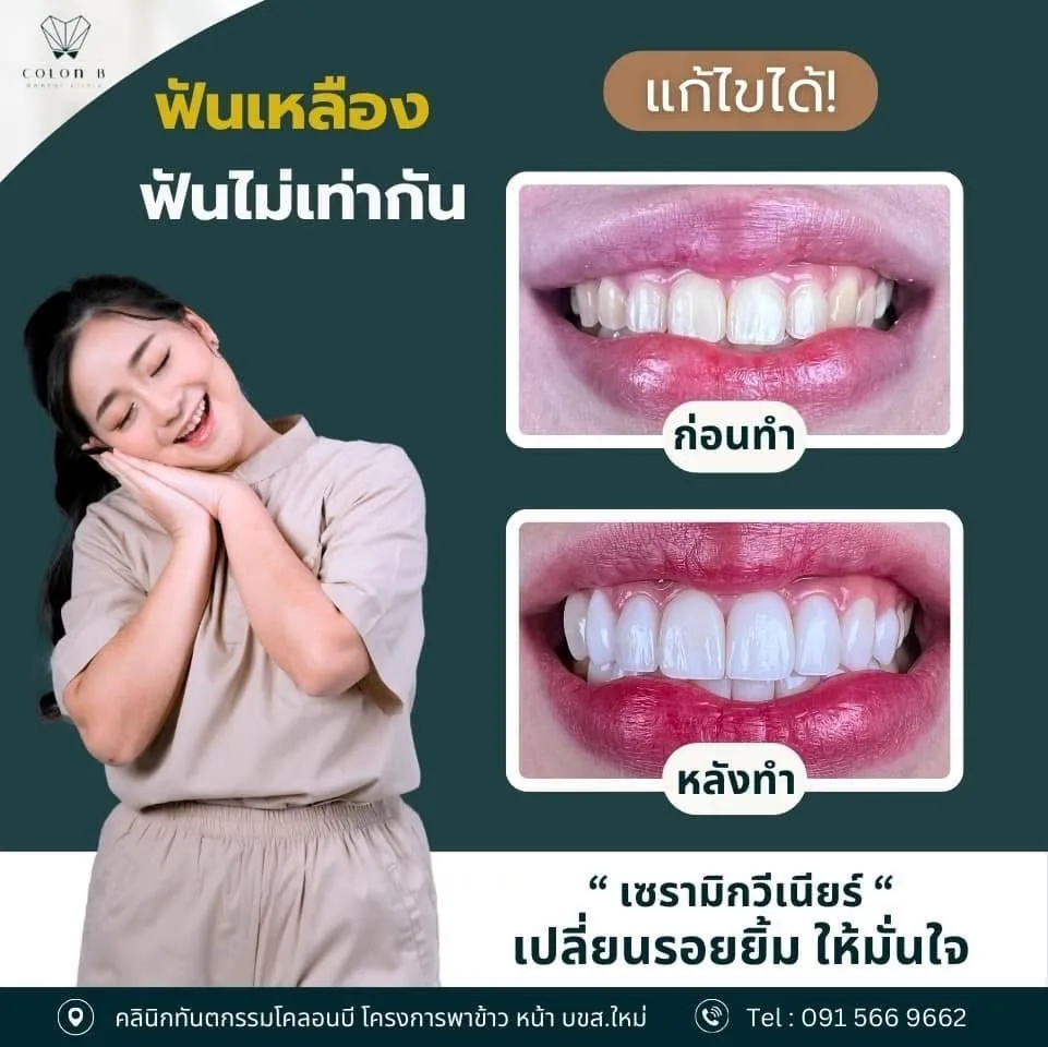 รีวิว วีเนียร์เซรามิก จากคนไข้จริง