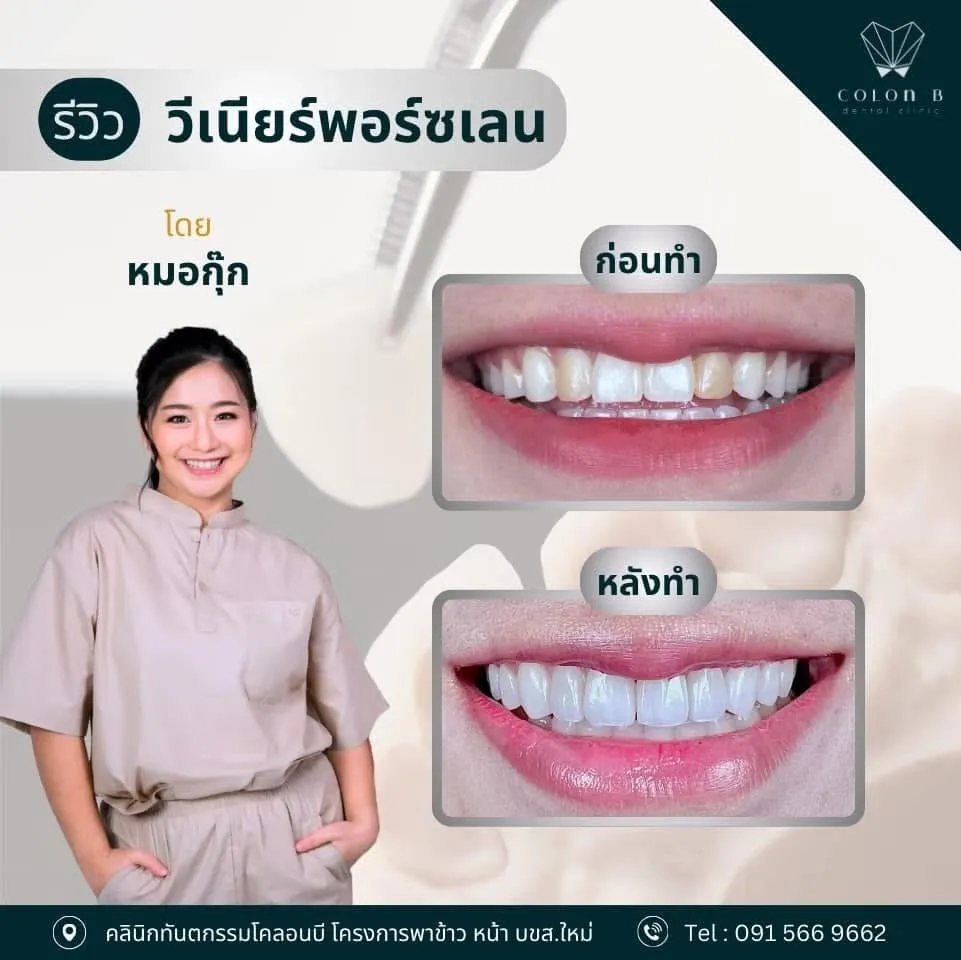 รีวิว วีเนียร์เซรามิก จากคนไข้จริง