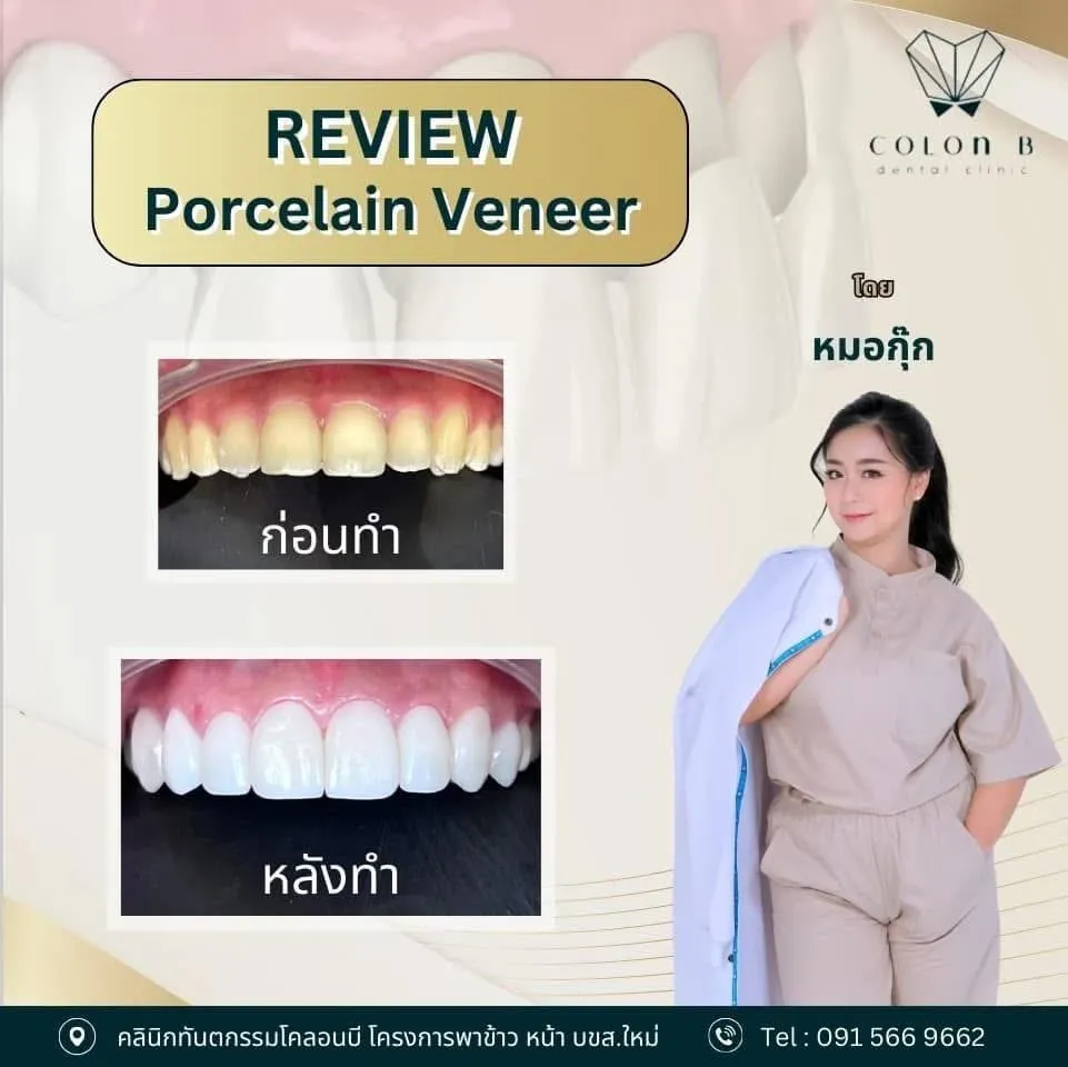 รีวิว วีเนียร์เซรามิก จากคนไข้จริง