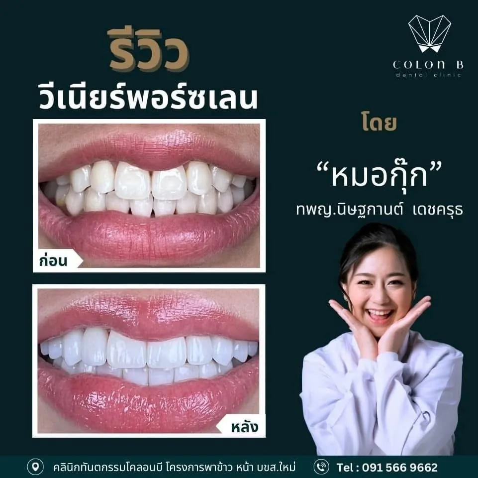 รีวิว วีเนียร์เซรามิก จากคนไข้จริง