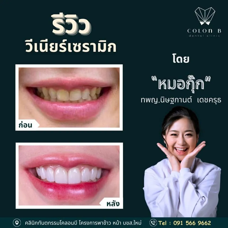 รีวิว วีเนียร์เซรามิก จากคนไข้จริง