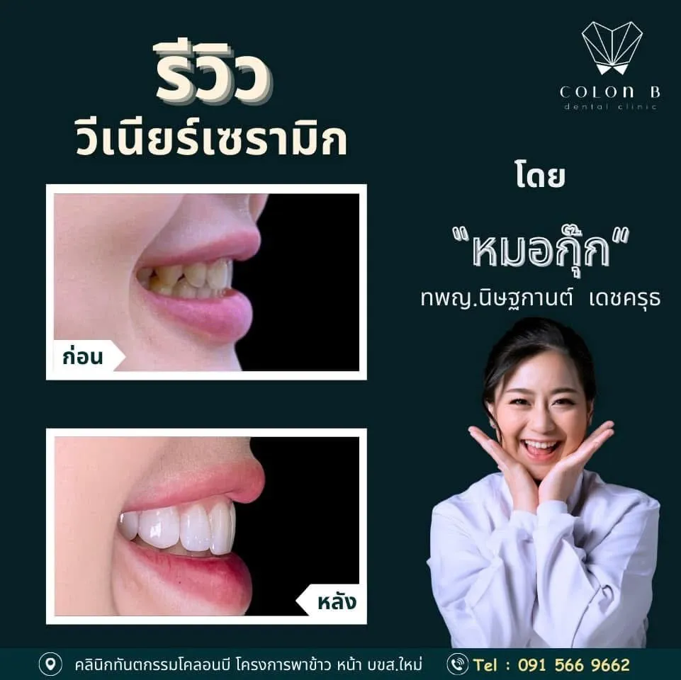 รีวิว วีเนียร์เซรามิก จากคนไข้จริง