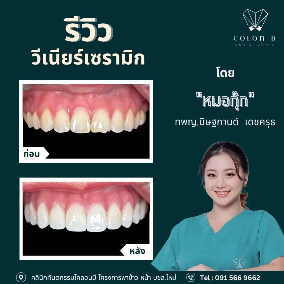รีวิว วีเนียร์เซรามิก จากคนไข้จริง