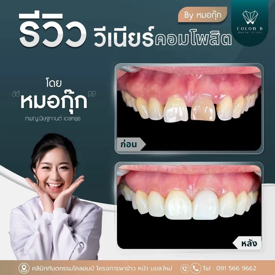 รีวิว วีเนียร์คอมโพสิต จากคนไข้จริง