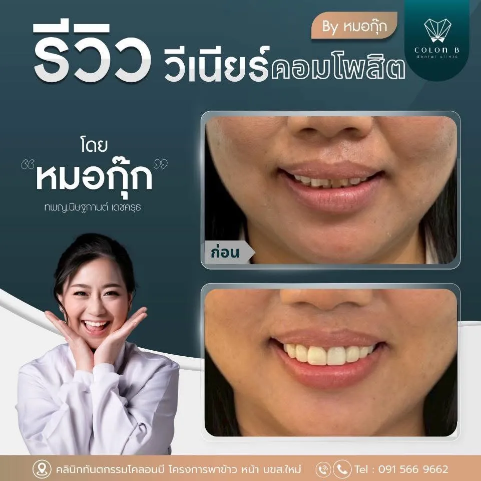 รีวิว วีเนียร์คอมโพสิต จากคนไข้จริง