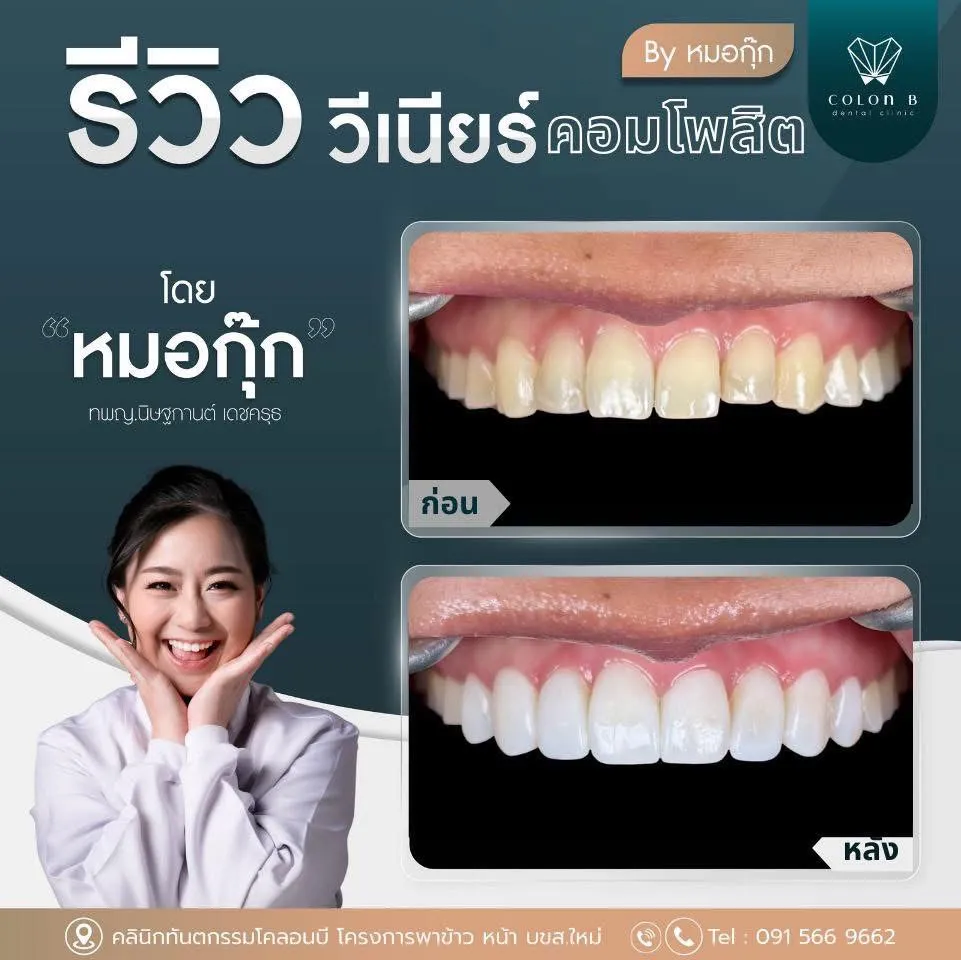 รีวิว วีเนียร์คอมโพสิต จากคนไข้จริง