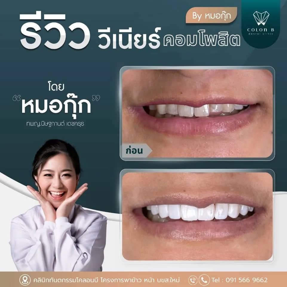 รีวิว วีเนียร์คอมโพสิต จากคนไข้จริง