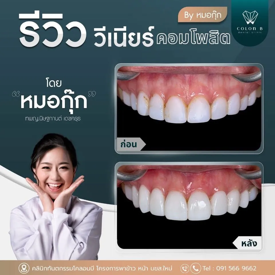รีวิว วีเนียร์คอมโพสิต จากคนไข้จริง