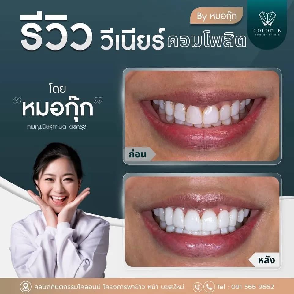 รีวิว วีเนียร์คอมโพสิต จากคนไข้จริง