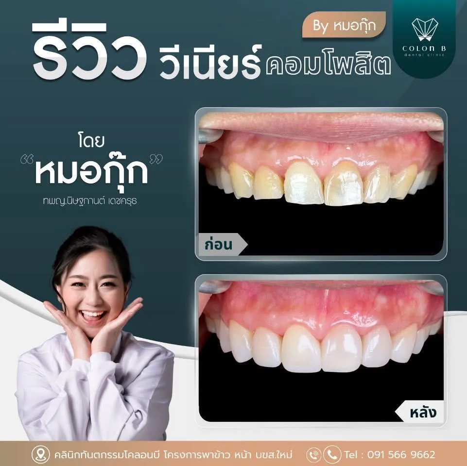 รีวิว วีเนียร์คอมโพสิต จากคนไข้จริง