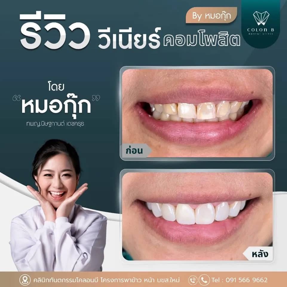 รีวิว วีเนียร์คอมโพสิต จากคนไข้จริง