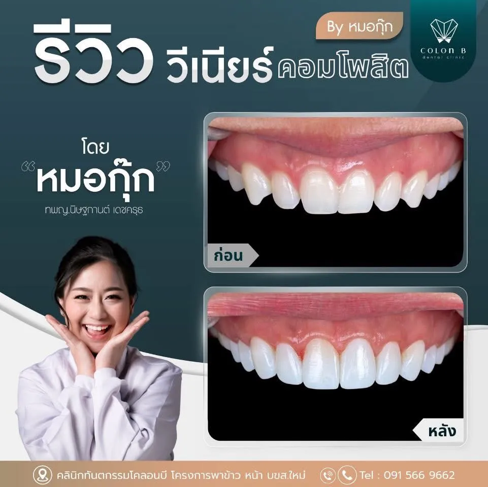 รีวิว วีเนียร์คอมโพสิต จากคนไข้จริง