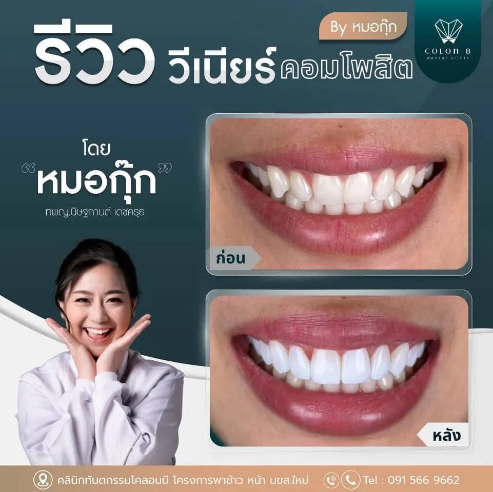 รีวิว วีเนียร์คอมโพสิต จากคนไข้จริง