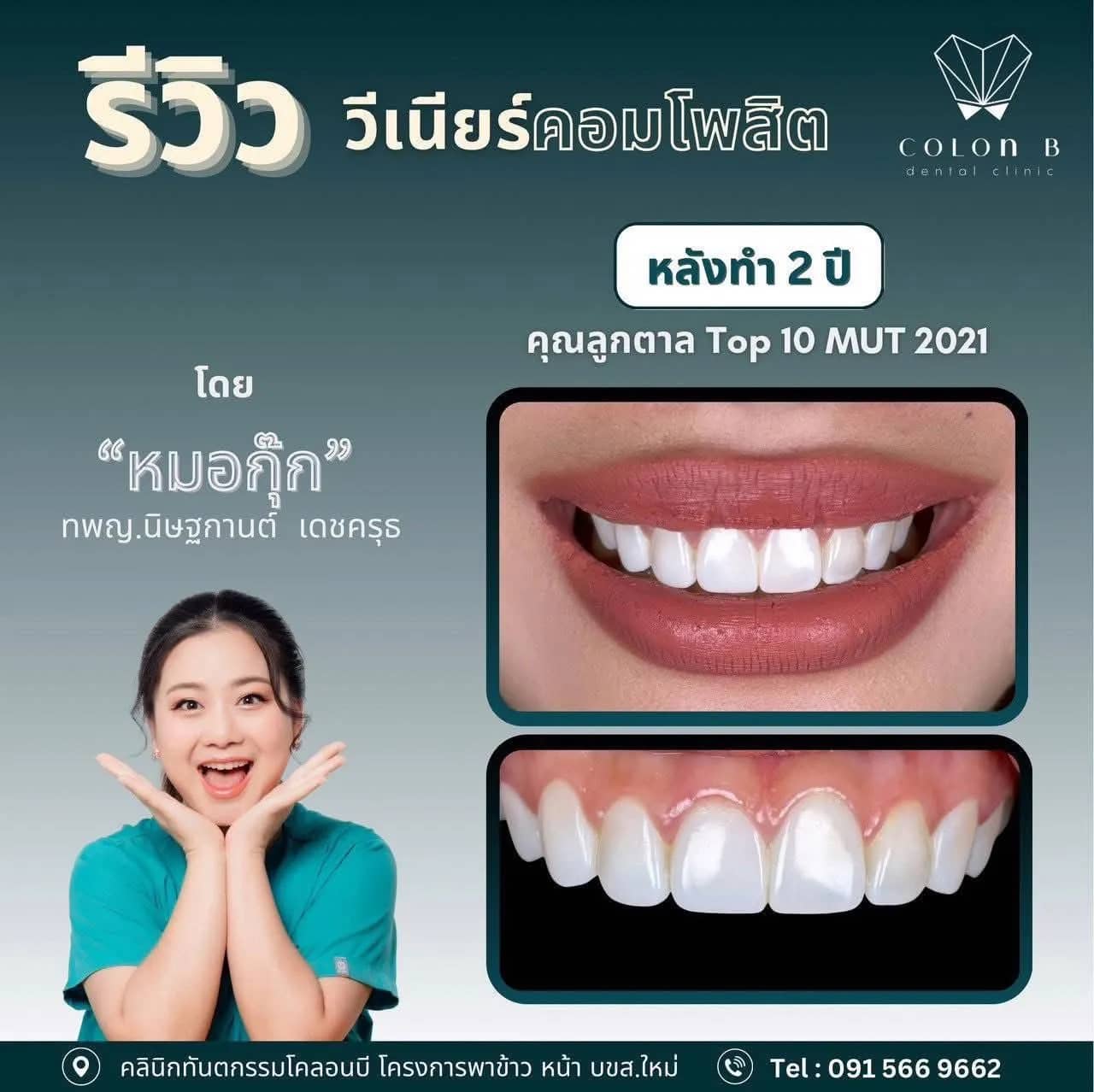 รีวิว วีเนียร์คอมโพสิต จากคนไข้จริง
