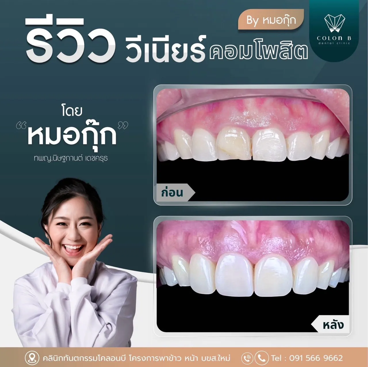 รีวิว วีเนียร์คอมโพสิต จากคนไข้จริง