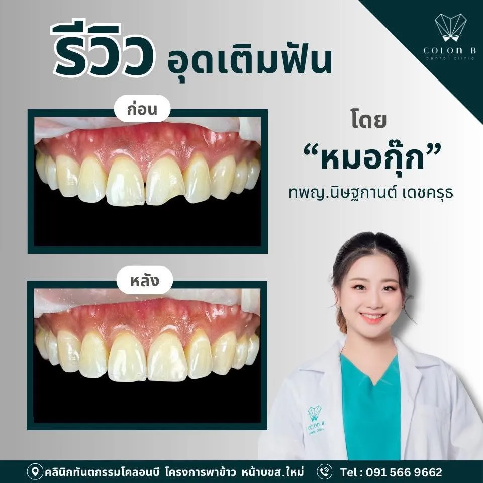 รีวิว อุดเติมฟัน จากคนไข้จริง