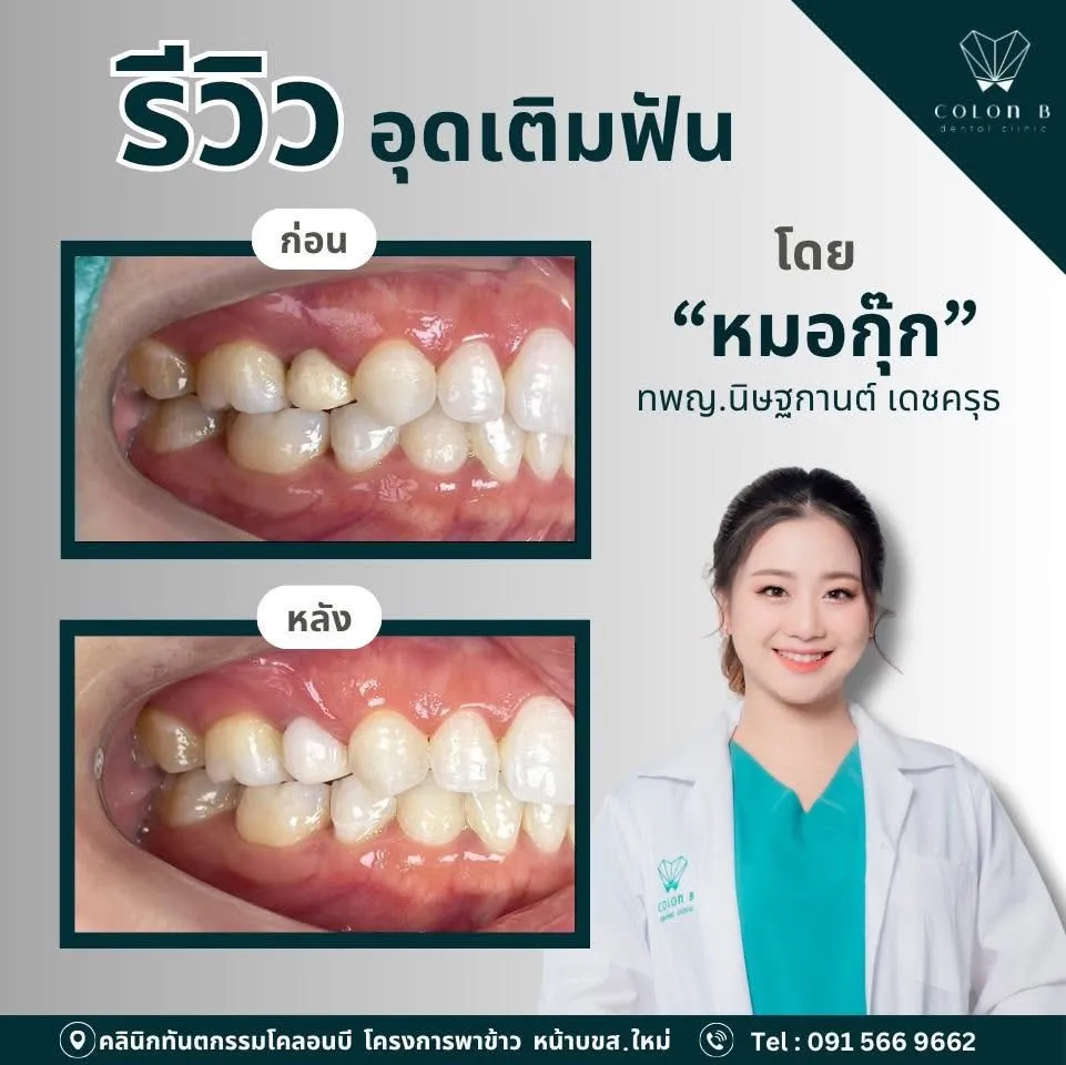 รีวิว อุดเติมฟัน จากคนไข้จริง
