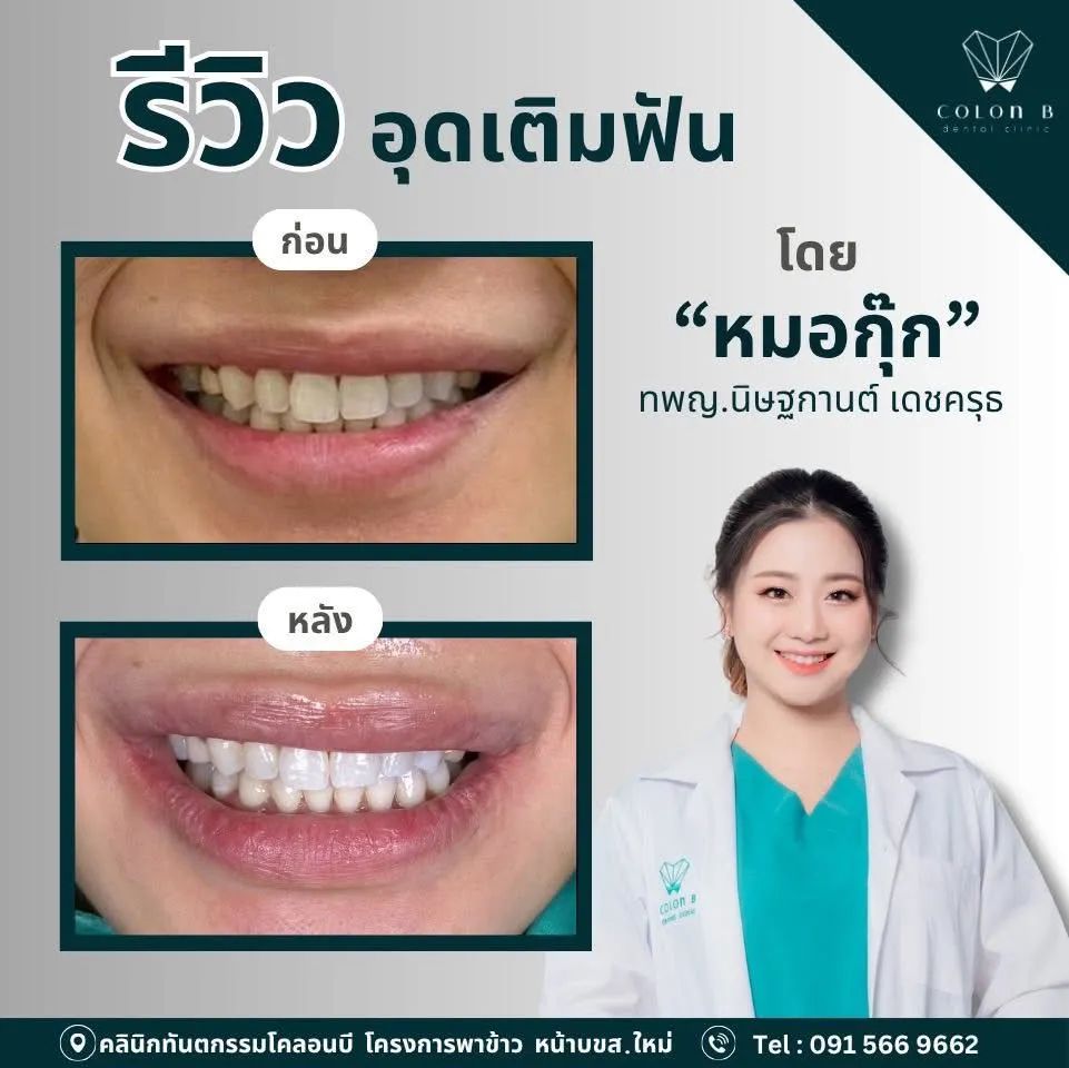 รีวิว อุดเติมฟัน จากคนไข้จริง