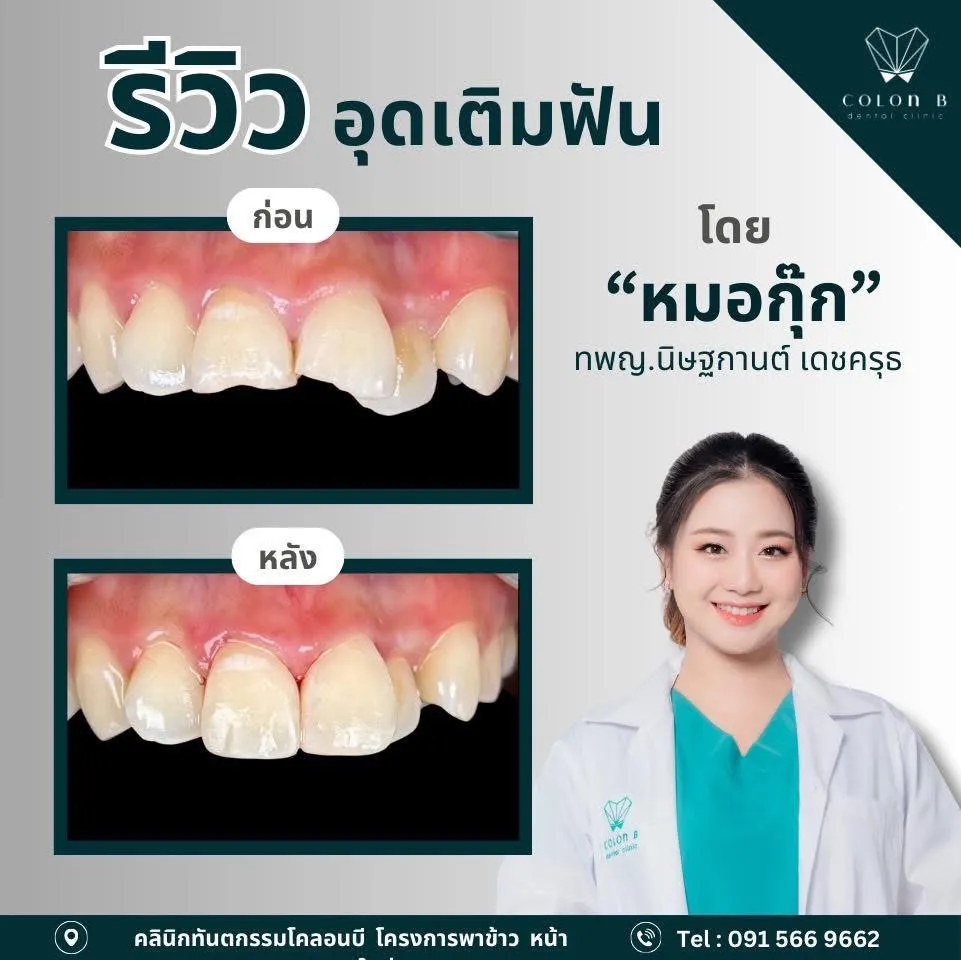 รีวิว อุดเติมฟัน จากคนไข้จริง