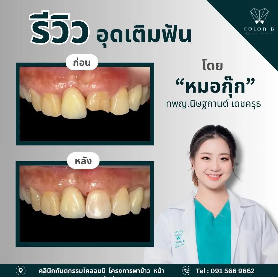 รีวิว อุดเติมฟัน จากคนไข้จริง