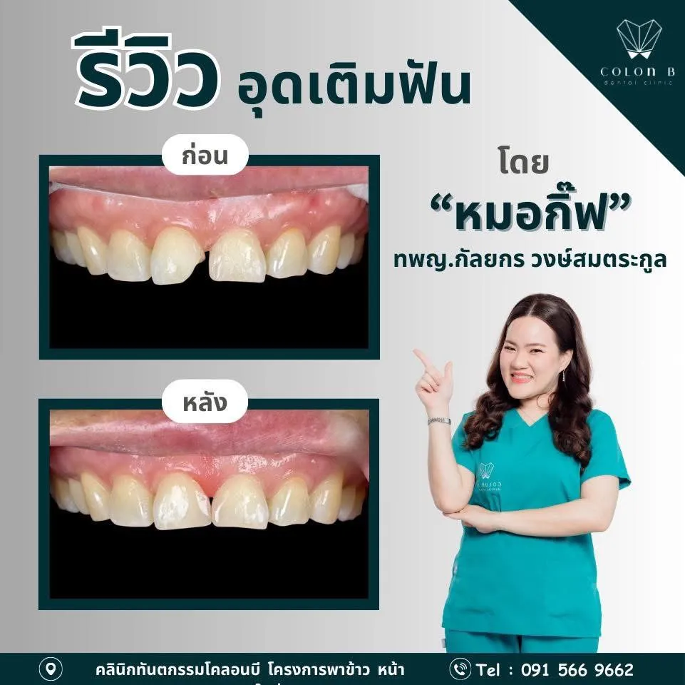 รีวิว อุดเติมฟัน จากคนไข้จริง