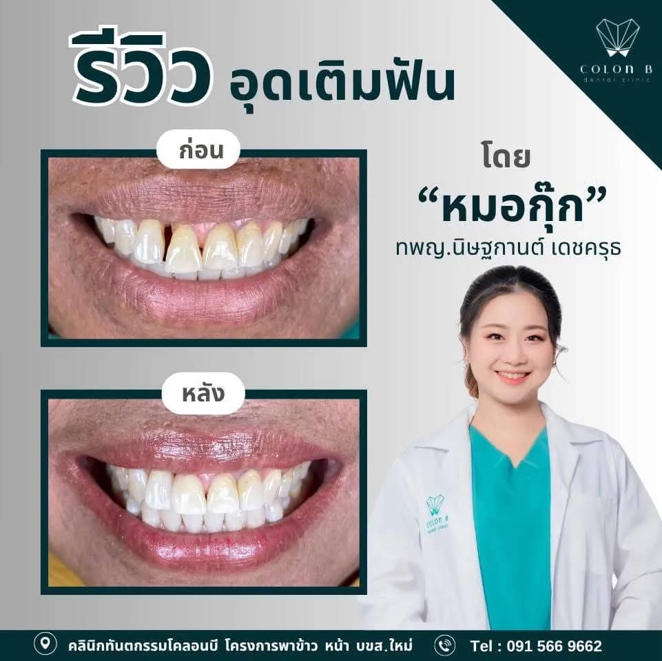 รีวิว อุดเติมฟัน จากคนไข้จริง