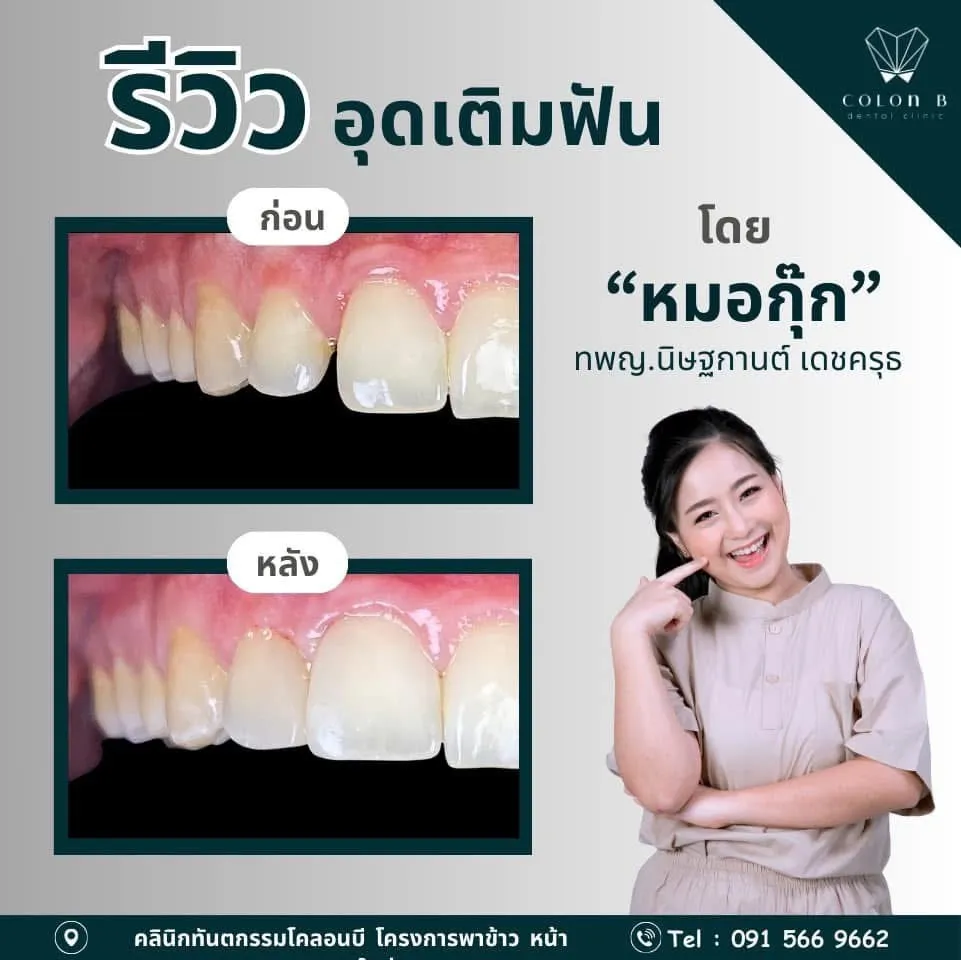 รีวิว อุดเติมฟัน จากคนไข้จริง