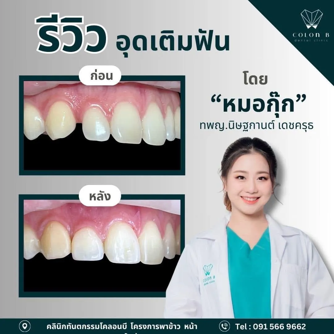 รีวิว อุดเติมฟัน จากคนไข้จริง