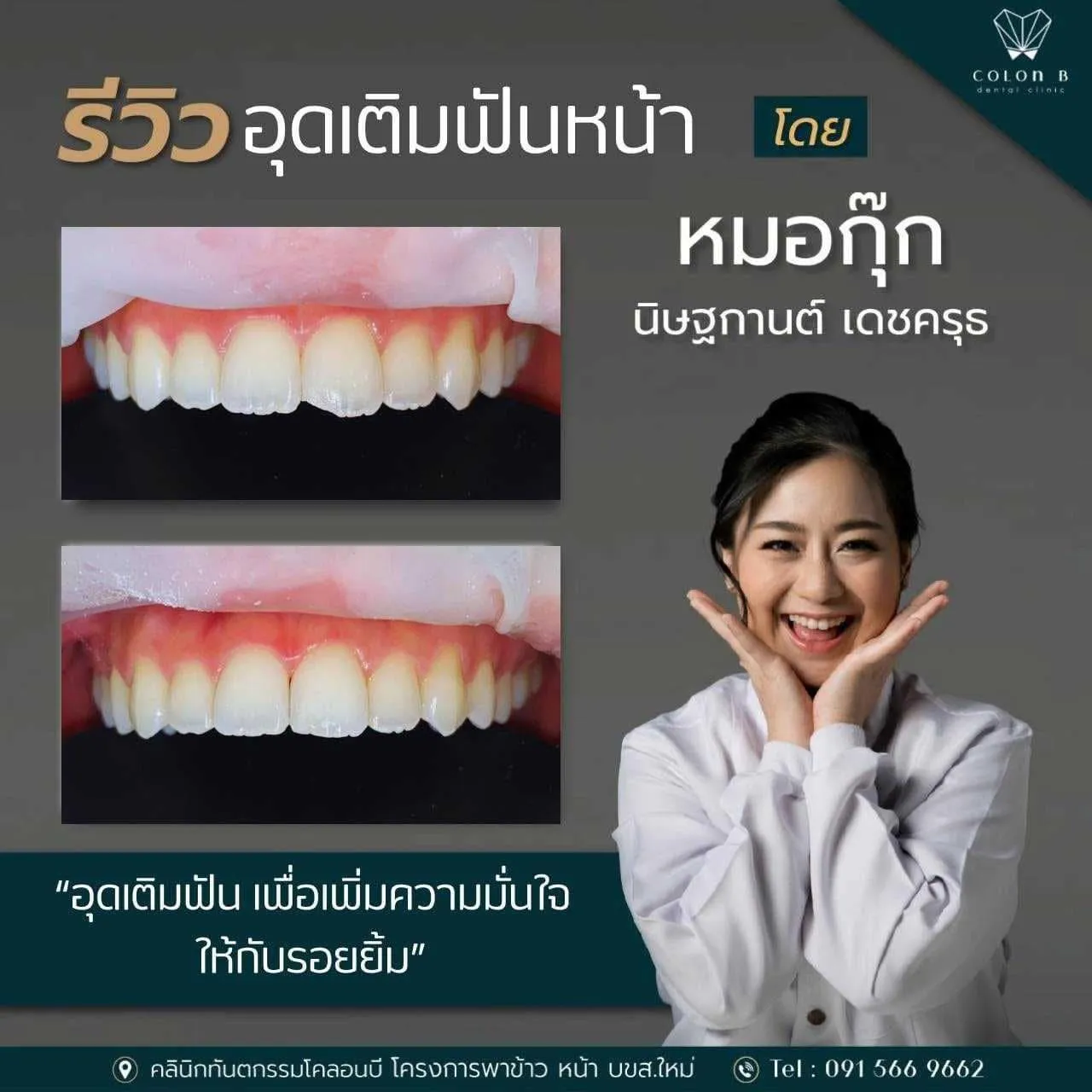รีวิว อุดเติมฟัน จากคนไข้จริง