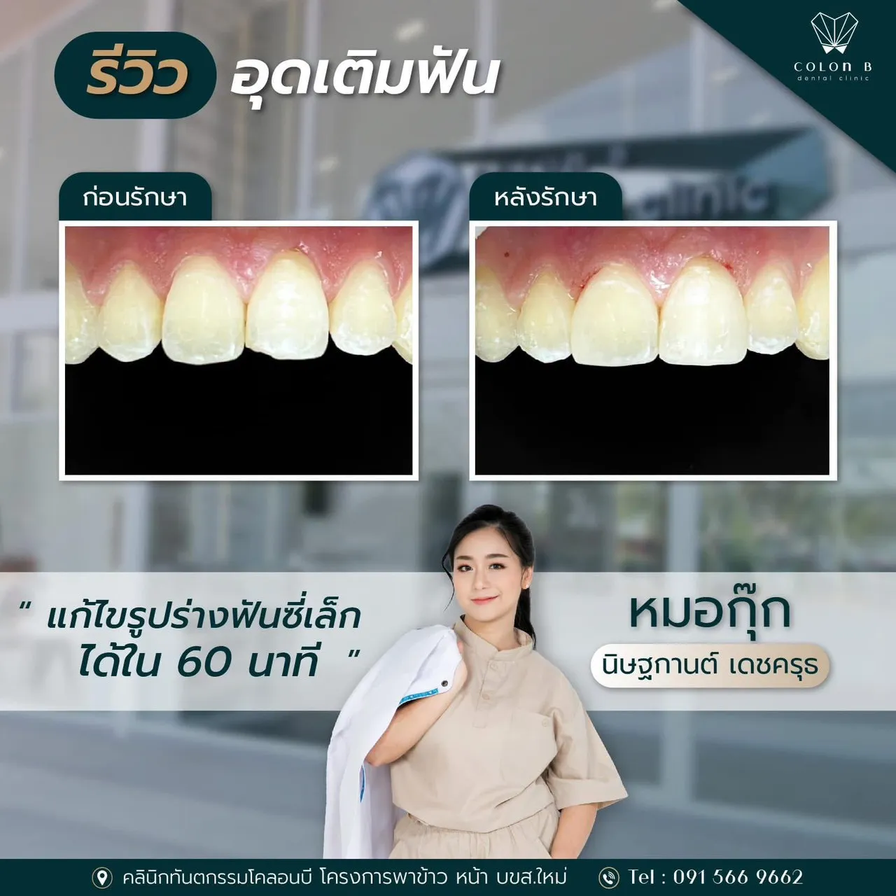 รีวิว อุดเติมฟัน จากคนไข้จริง