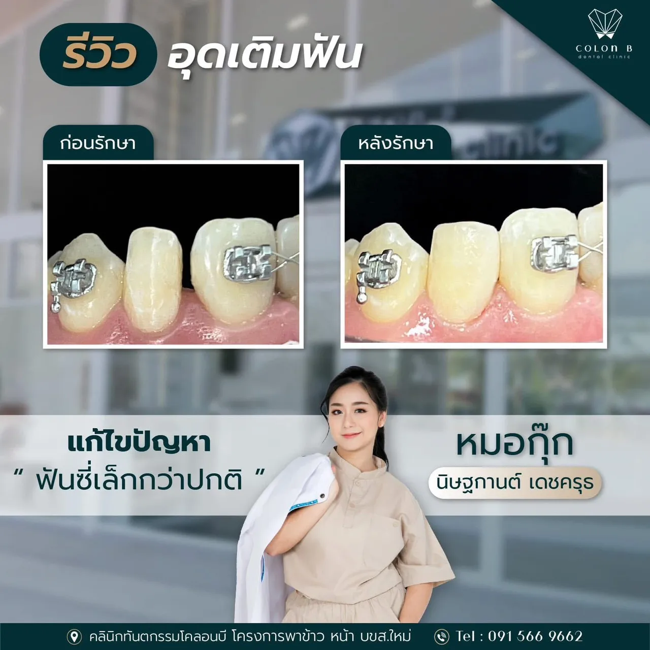 รีวิว อุดเติมฟัน จากคนไข้จริง