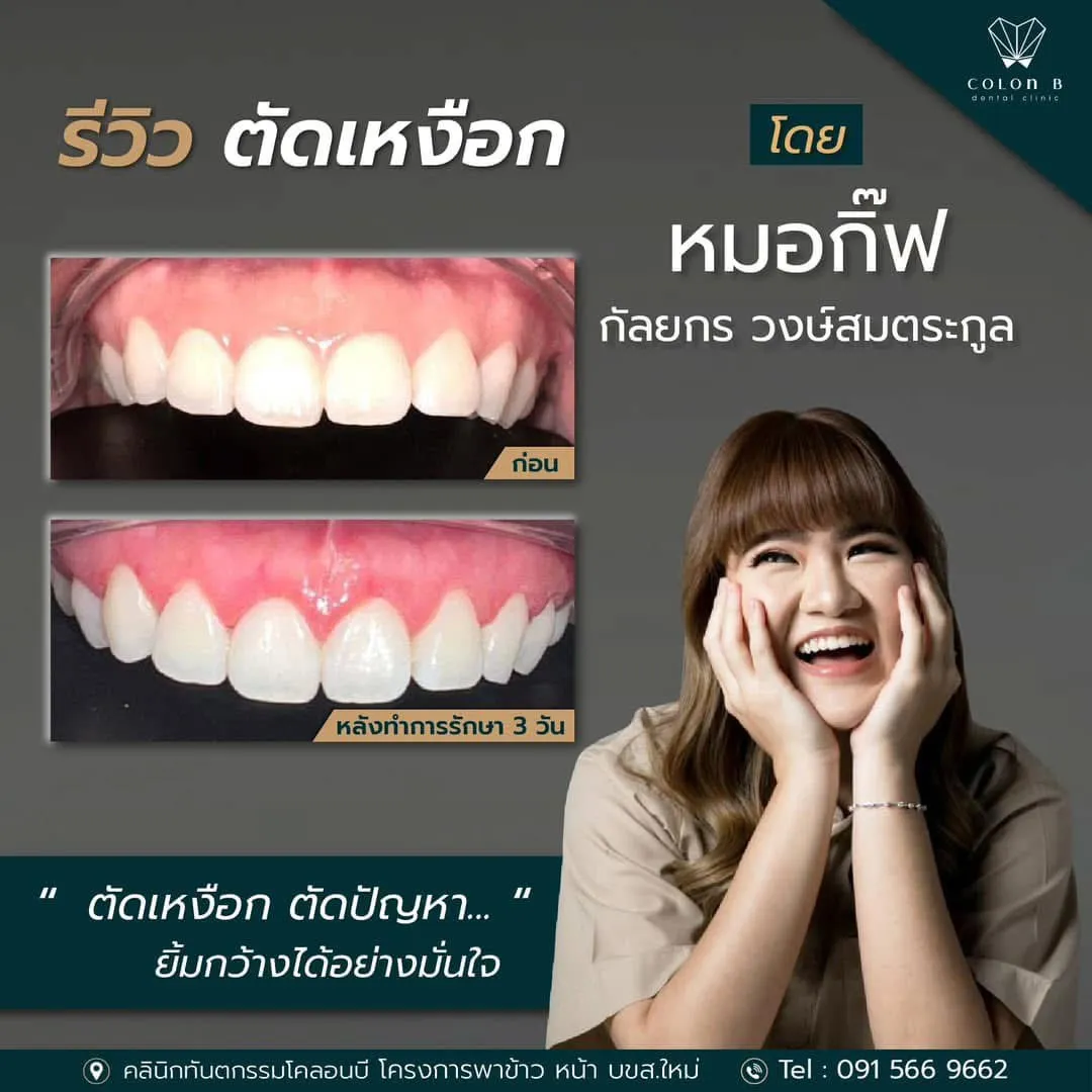 รีวิว ตัดแต่งเหงือก จากคนไข้จริง