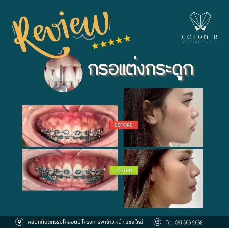 รีวิว ตัดแต่งเหงือก จากคนไข้จริง