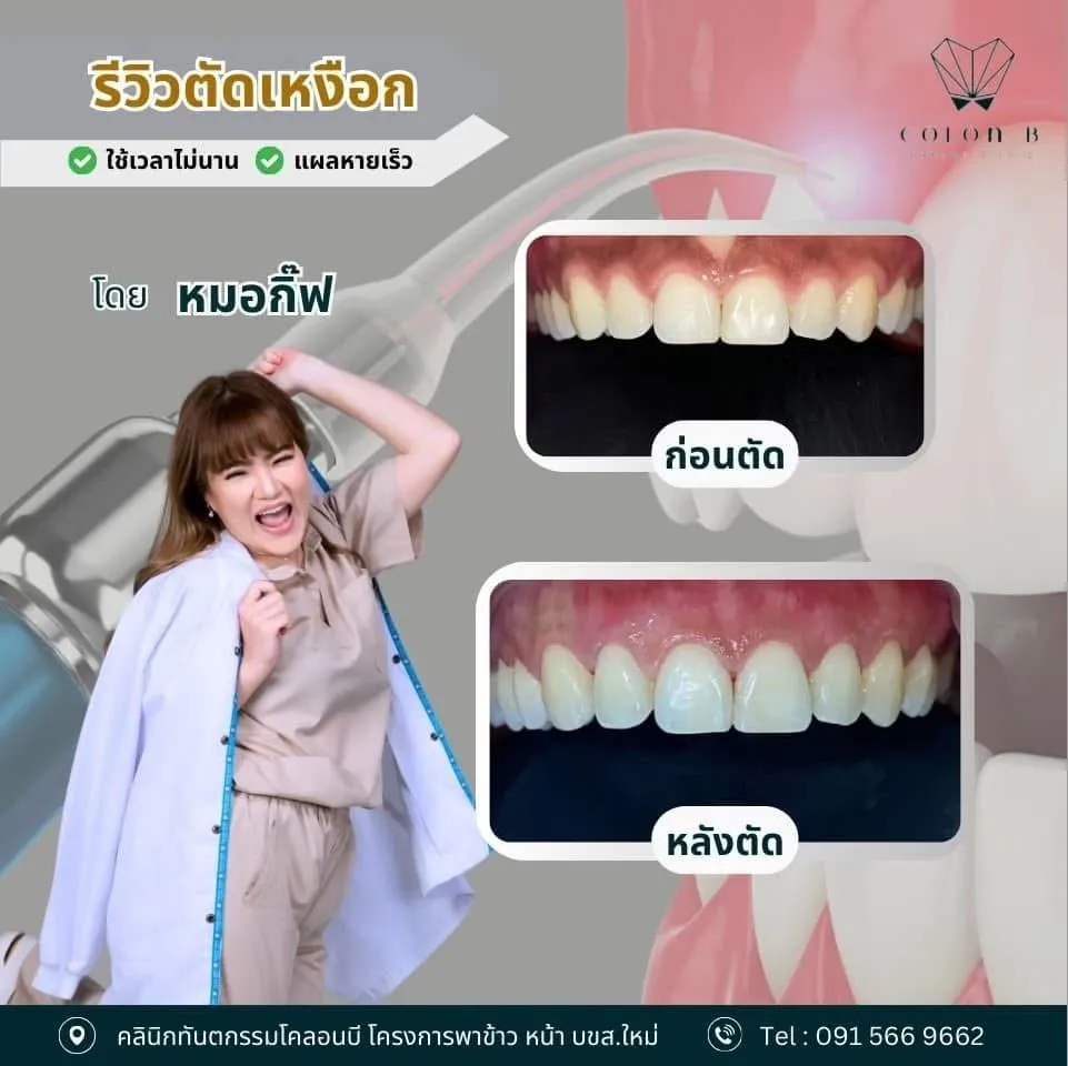 รีวิว ตัดแต่งเหงือก จากคนไข้จริง