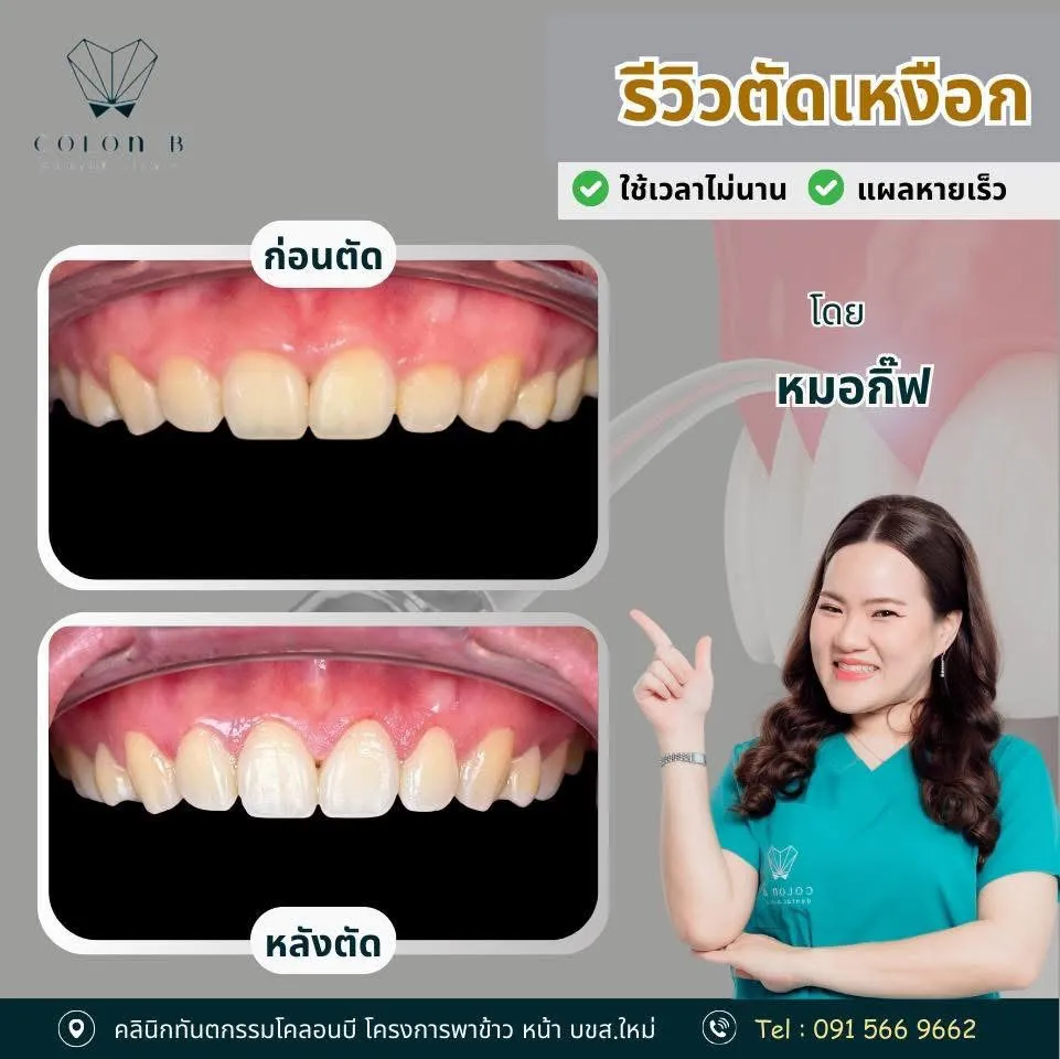 รีวิว ตัดแต่งเหงือก จากคนไข้จริง