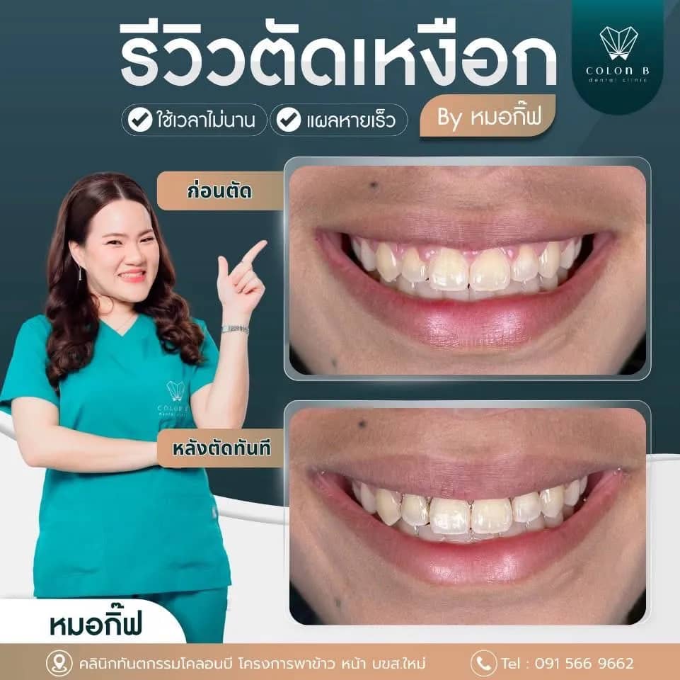 รีวิว ตัดแต่งเหงือก จากคนไข้จริง