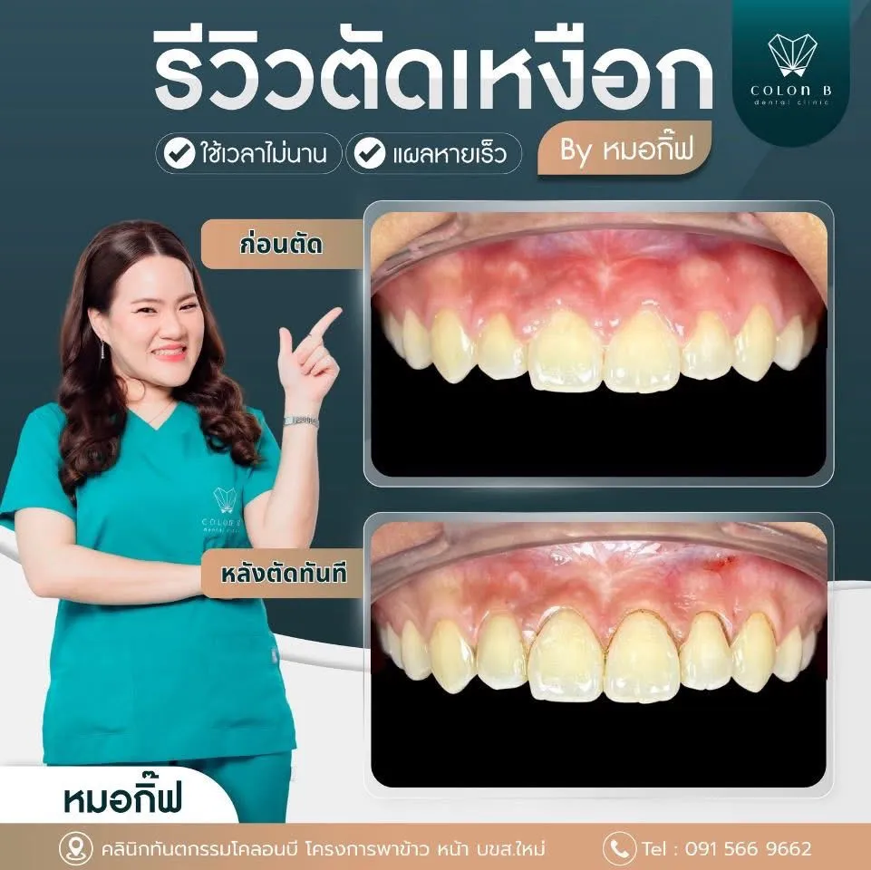 รีวิว ตัดแต่งเหงือก จากคนไข้จริง
