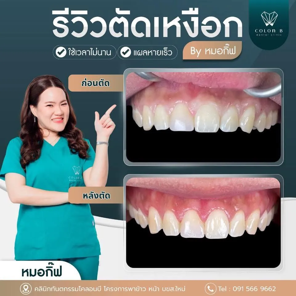 รีวิว ตัดแต่งเหงือก จากคนไข้จริง