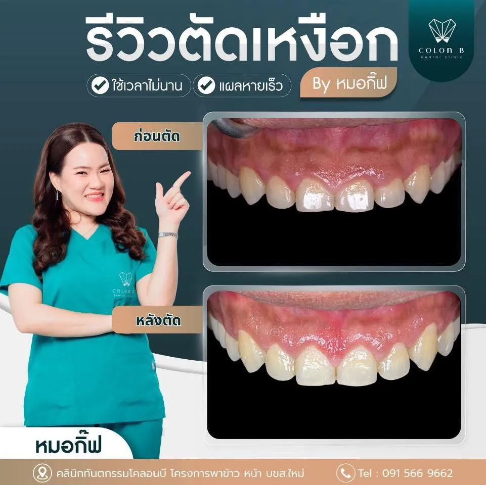รีวิว ตัดแต่งเหงือก จากคนไข้จริง