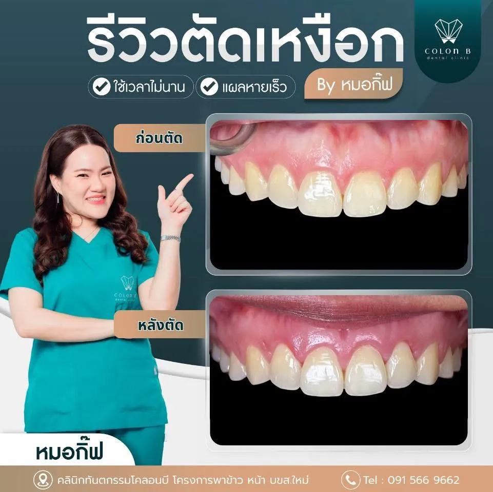 รีวิว ตัดแต่งเหงือก จากคนไข้จริง
