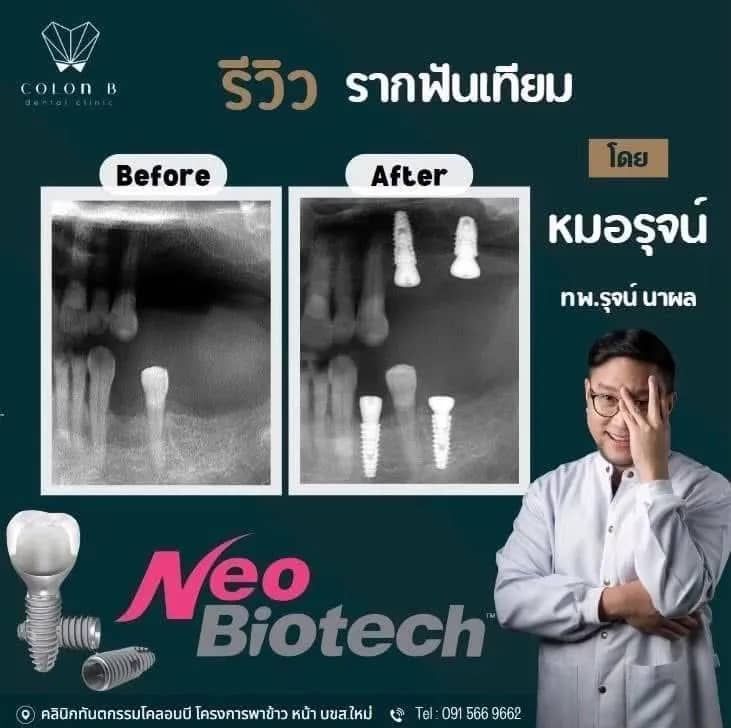 รีวิว รากฟันเทียม จากคนไข้จริง