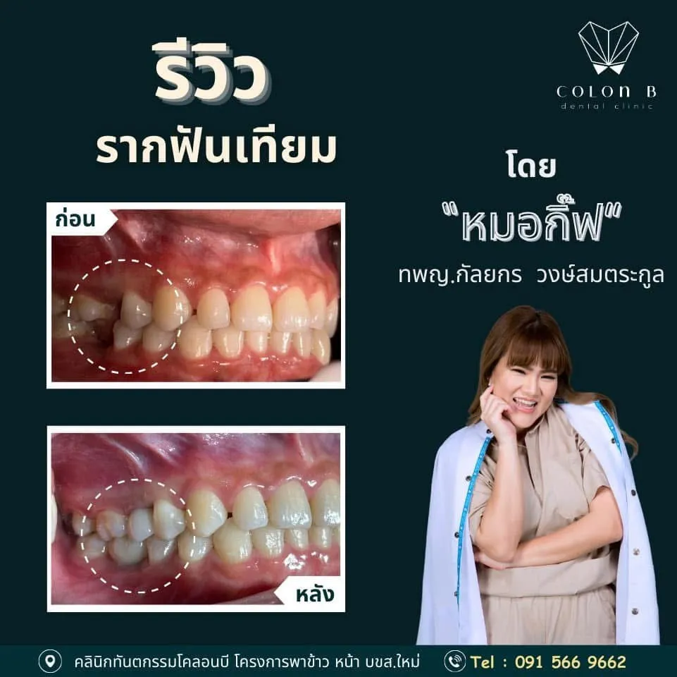 รีวิว รากฟันเทียม จากคนไข้จริง