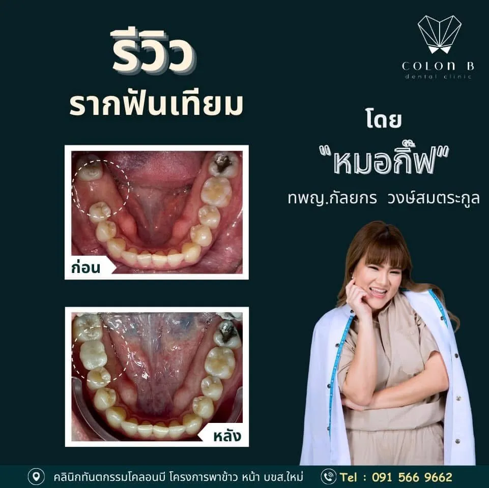 รีวิว รากฟันเทียม จากคนไข้จริง