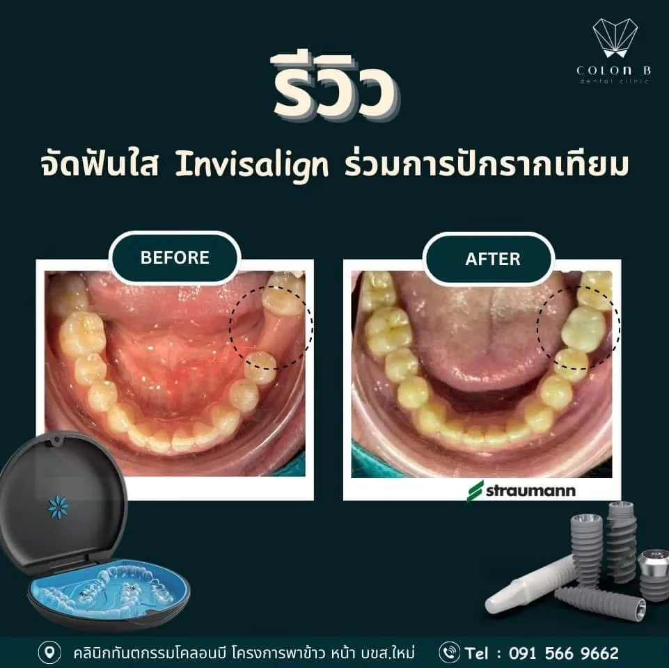 รีวิว รากฟันเทียม จากคนไข้จริง