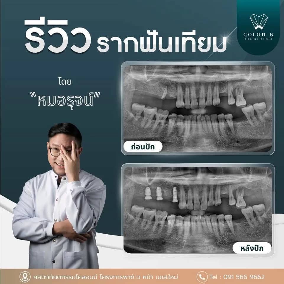 รีวิว รากฟันเทียม จากคนไข้จริง